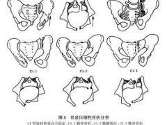 盆底修复和骨盆修复